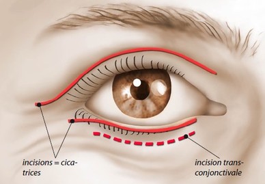 blefaroplastia transconjuntival